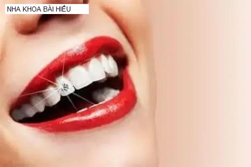 Hình ảnh NHA KHOA BÀI HIẾU